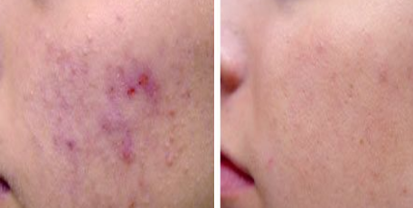 Acne Seborrhoea Lzeres Kezelse