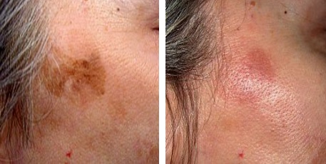 Brhibk Kezelse Lzerrel