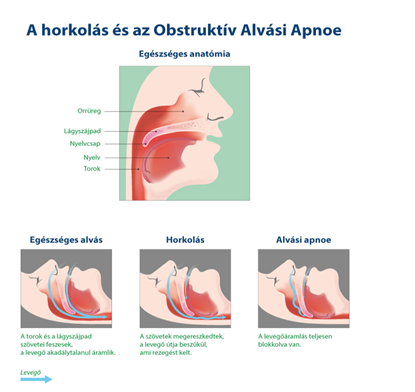 Fjdalommentes Horkols Elleni Kezels