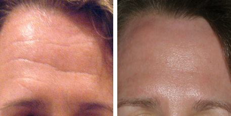 Homlokrnc Lzeres Kezelse