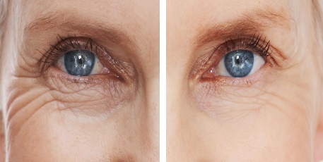 Lzeres Szemrnc Eltvolts