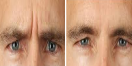 Szemldk Kzti Rnc Lzeres Eltvoltsa